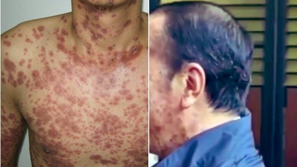 Jokowi Diduga Terpapar Sindrom Langka yang Bisa Sebabkan Kematian